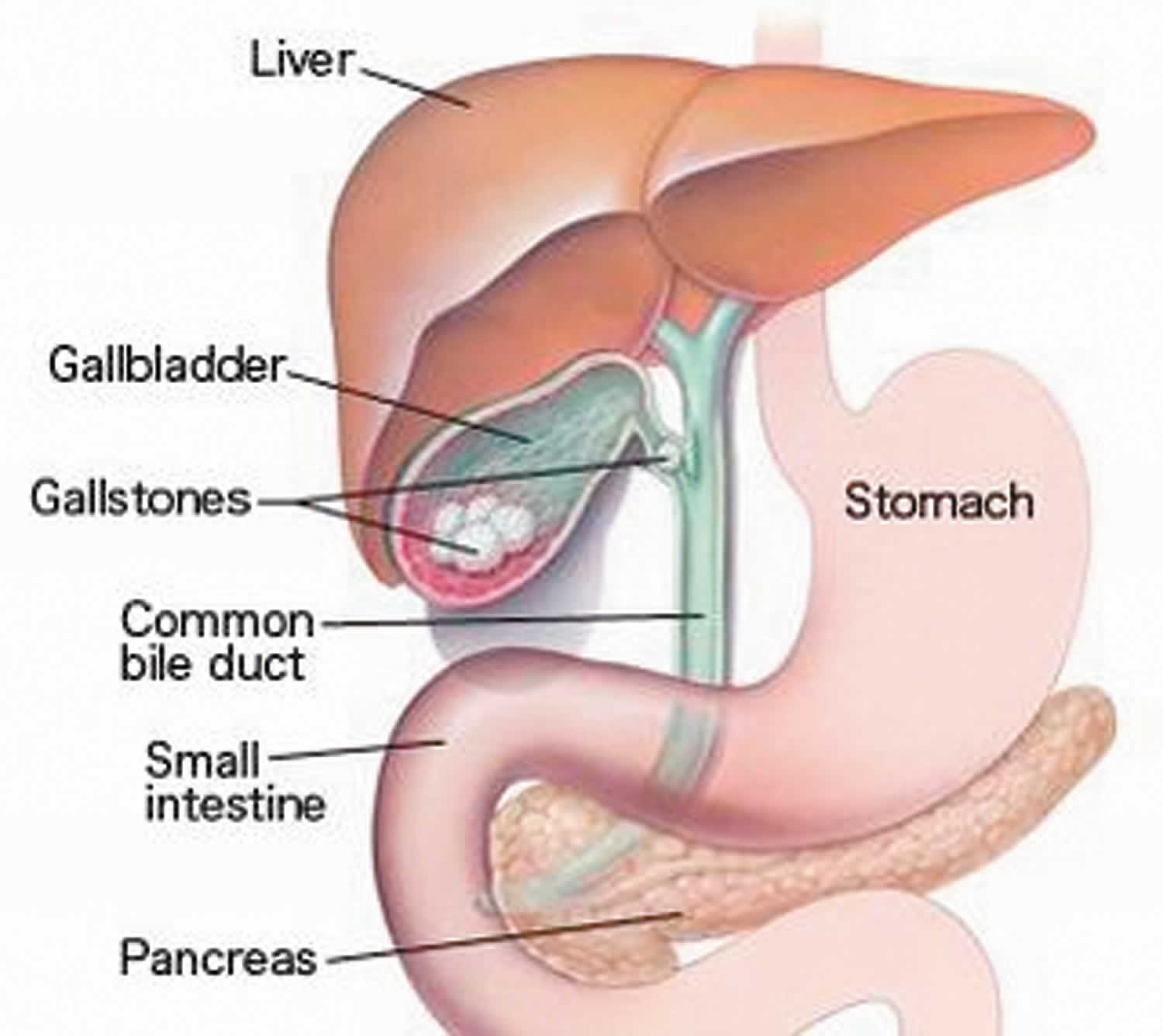 Calculus Of Gallbladder With Chronic Cholecystitis Without Obstruction Icd 10