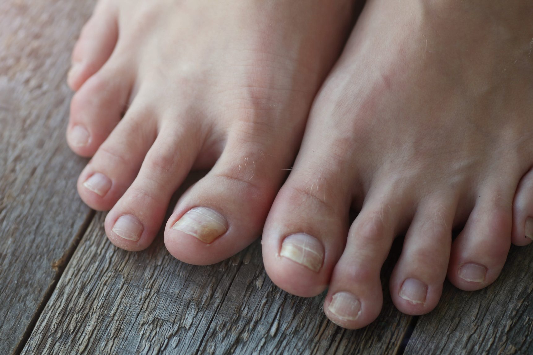 Nail Fungus Treatment Natural Means