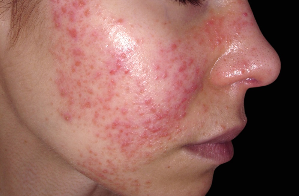 Systemic lupus erythematosus